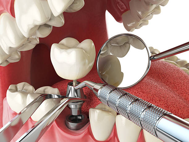 Best Emergency Dental Filling Replacement  in Bidwell, OH